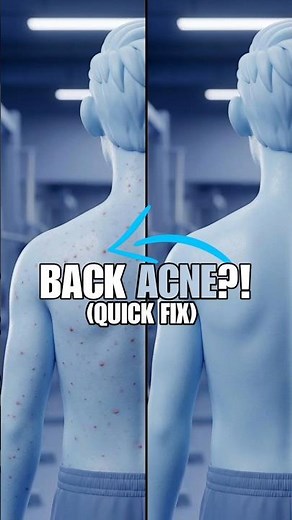Back Acne Explained (Causes + Quick Fix) 😥❌🧑‍⚕️
