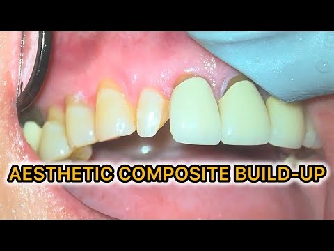 Broken Front Tooth? Class IV Composite Restoration Step-by-Step (Aesthetic Dentistry Workflow)