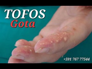 😈 La Gota y los Tofos Una Mirada Completa a la Enfermedad del Ácido Úrico y sus Complicaciones