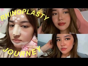 MY RHINOPLASTY JOURNEY (2 WEEKS POST-OP) | Andrea Angeles