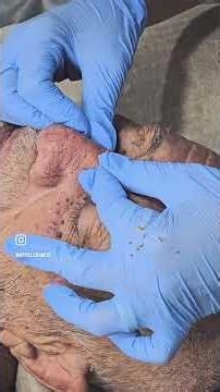 Addictive Blackhead Extraction 🔥 #skincareroutine #skincareroutine #skincare #acnetreatment