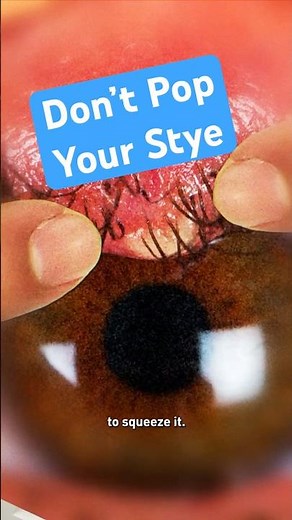 Don’t Pop Your Stye