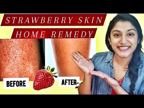 HOW TO treat KERATOSIS PILARIS/STRAWBERRY SKIN/CHICKEN SKIN at home | Ingrown hair on arms & legs🌼