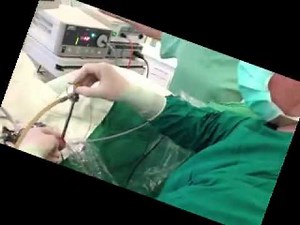 Transurethral resection of prostate