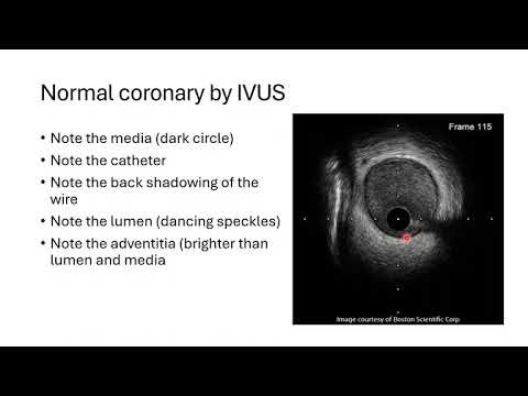 IVUS basics and image interpretation