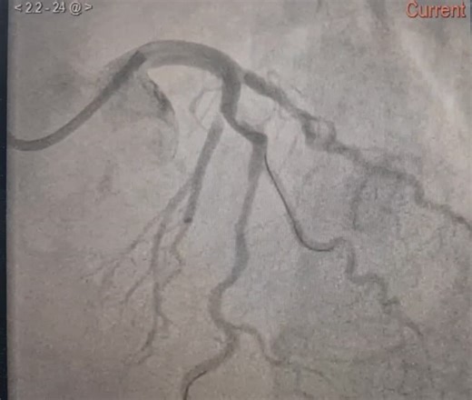 Stent deformation in PCIWe always think of proximal LSD due to inadvertent GC interaction. And we know distal SD can occur in retrograde procedures and when removing jailed distal equipment. But… | Sarah Fairley