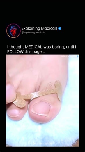 Medical | Health | Anatomy on Instagram: "This short tutorial demonstrates a simple toe-taping technique using gold mesh tape to create custom toe separators. By gently spacing overlapping or crowded toes, this method helps reduce friction, improve alignment, and relieve pressure that can lead to pain, corns, or nail problems. Toe separation is commonly used in podiatry and physiotherapy to support proper toe positioning, especially during pedicures, prolonged standing, or while wearing tight fo