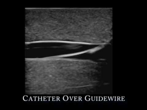 Femoral Line Ultrasound Training Model
