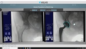 Anterior Hip Approach Workflow Overview: How to Utilize a Hip Navigation System