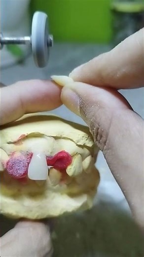 Making Partial Denture