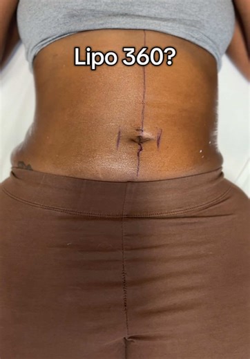 LISTEN UP, POST-OPS! 📣 You got the surgery, but life happened, and now you need a tweak? We see you! Client had Lipo 360 a year ago and regained some volume. SOLUTION: Non-surgical Precision Melt for quick, targeted refinement. Look at this definition immediately after her session! It’s not about starting over. It’s about maintaining your investment! ➡️ POST-OP TOUCH-UP? Click the Link in Bio to book your session! #PostOpLife #LipoMaintenance #SurgeryRefinement #PrecisionMelt #Covelab #BodyScul