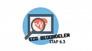 ECG Beoordelen – stap 6.3 (STEMI) - ECG Academie