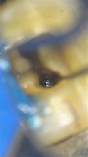 Abdullah AboHalima on Instagram: "From A–Z Biology-Driven Retreatment Case -Conservative separated file removal -Large periapical lesion management (negative pressure, LID technique obturation) Using Endocem+Ednoseal @maruchi_endo -Final restoration"