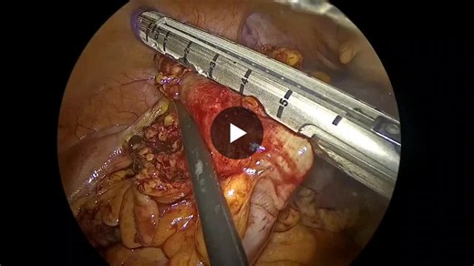 As a Biomedical Engineering Technician, it is always inspiring to see how advanced surgical technologies contribute to improved clinical outcomes. Proud to witness innovation that supports surgeons… | Muhammed Suhail