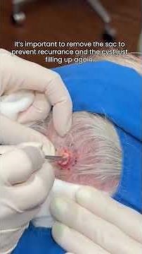 Another Pilar Cyst Bites the Dust... #drpimplepopper #Popaholics #dermatology