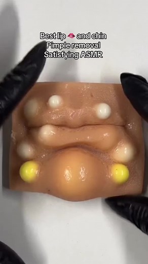 Pimple Popping ASMR: Best Lip and Chin Experience