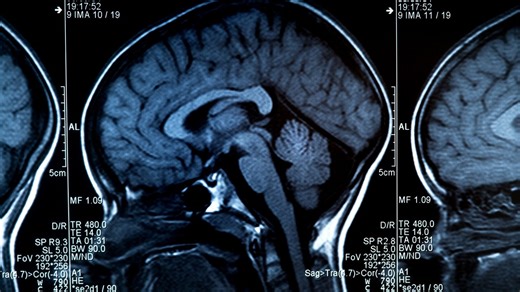 Alzheimer’s disease could be reversed by restoring brain balance, study suggests