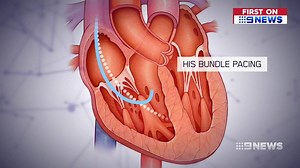 Pacemakers, the life-saving devices many Australians rely on to keep their hearts beating normally, can have serious side effects. #9News | http://9News.com.au | 9 News Melbourne