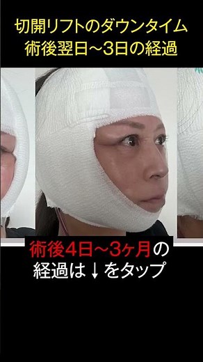 Revealing the downtime for incision lift #Mizunomori Beauty Clinic #Mizunomori #Mizunomori Cosmet...
