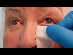 Botulinum toxin for entropion SD 480p