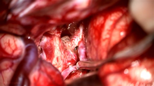 #415: Occlusion In Situ Technique for an Optic Chiasm Arteriovenous Malformation - All Videos - Seven Series Collection