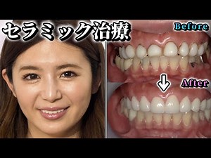 【ビフォアフター】現役セクシー女優セラミック治療アフタートーク！歯のコンプレックスを乗り越えて理想の歯並びを手に入れることはできたのか！？林医師が徹底解説！
