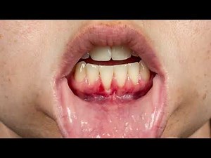 Why Do My Gums Hurt in One Spot? | Dentist Explains Causes & Treatment