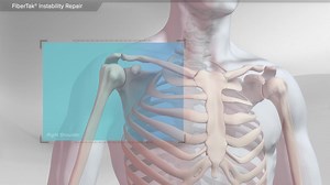 FiberTak® Instability Repair