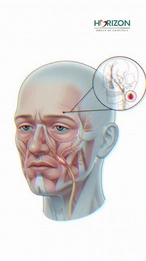 Stroke Signs You Must Know: Act F.A.S.T. to Save a Life.