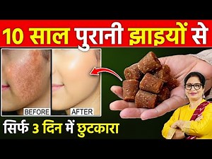 सिर्फ 3 बार में कितनी भी पुरानी झाइयां, काले दाग-धब्बो से 100% छुटकारा | Jaggery Benefits For Face