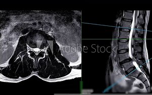 MRI L-S spine or lumbar spine Axial T2W view with sagittal plane for diagnosis spinal cord compression.