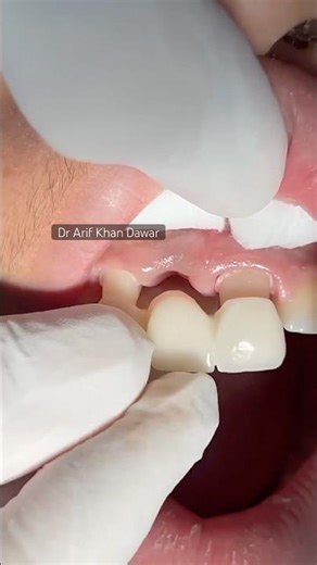 Missing Teeth Replaced by Zirconia Bridge 😍 #shortvideo #dentist #dentalartistry