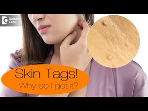 5 Things to know about Skin Tags| Why do I get it?|Best Treatment - Dr. Divya Sharma|Doctors' Circle