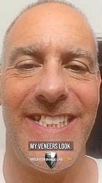 Why I'm NEVER Going Back to Normal Teeth After Trying Brighter Image Lab Veneers