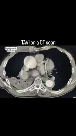 Exploring TAVI/TAVR on CT Scans
