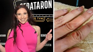 Let Us Close Class Windows, Maltese Teacher Appeals As She Posts Chilblains Photo