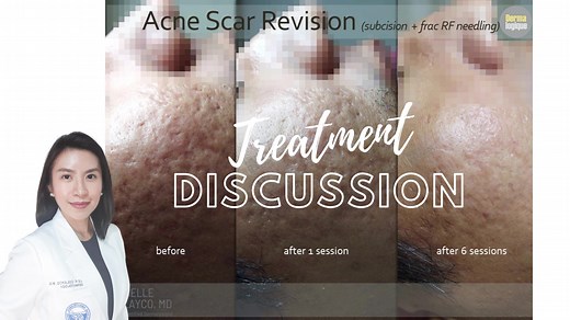 #AcneScarRevision : #subcision #fractionalrfmicroneedling