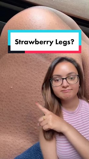 How to Get Rid of Strawberry Legs: Effective Solutions
