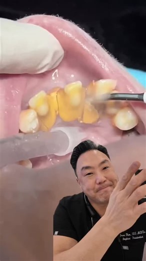 New York Dental Solutions on Instagram: "Calculus buildup? Here’s what helps. Tartar cannot be removed at home. Professional cleanings, scaling, and—when needed—deep cleanings help remove buildup and protect gum health. Daily brushing, flossing, and regular dental visits help prevent it from returning"