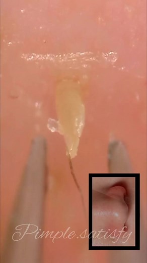 blackheads removal ,Close up 200x #acne #satisfying #blackheads #fyp #blackhead #foryou #pimple #blackheadsremoval