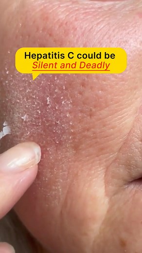 19 reactions | Find out why hepatitis C is silent but deadly — know its symptoms! | Health and Hygiene | Facebook