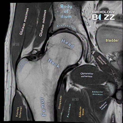 🧲MRI HIP JOINT ANATOMY – CORONAL VIEW😊 This beautifully labeled coronal MRI of the hip joint highlights the detailed anatomy of the femoral head & neck, acetabulum, body of ilium, and surrounding muscle groups including the gluteals, iliopsoas, obturator muscles, and adductors. Understanding normal MRI anatomy is the foundation for detecting pathology such as avascular necrosis, labral tears, fractures, muscle injuries, and hip impingement syndromes. 📌 Perfect reference for radiographers, rad