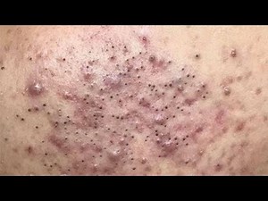 Satisfying Relaxing with Vien Tham My DrAZI #vienthammydrazi0009 #acne #pimples