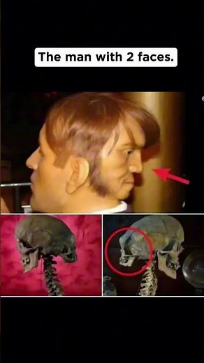 These People Have Conditions You've Never Seen 😨 #rare #medical #shocking