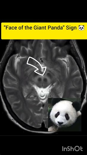 Why is there a PANDA in the Brain? 🐼🧠 #educational #radiology #shorts
