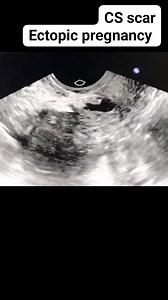 639 reactions · 118 shares | CS scar ectopic pregnancy on ultrasound #educationalreels #baby #radiology #education #medical #pregnancy #LoveUltrasound #ultrasound #fblifestyle #pregnant | Radiology Interesting | Facebook