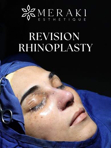 Revision rhinoplasty. ✨ A second chance at balance, refinement, and confidence—thoughtfully planned for natural results. Book a consultation and take the next step in your transformation. #Rhinoplasty #FaceLift #MiniFaceLift #BeforeAndAfter #RhinoplastyPhilippines #MerakiEsthetique This video is for educational and informational purposes only. Results vary per individual. Always consult a licensed professional for personalized advice.