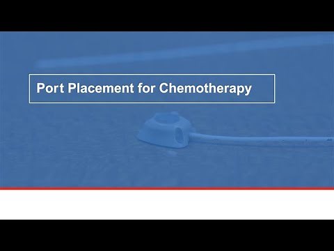 Port placement for chemotherapy