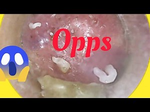 Biggest Acne Explosion Ever!:The Popping Moment:Calming Skincare Therapy for Relaxation: