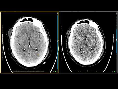 Brain Trauma — Intraventricular Hemorrhage on MRI